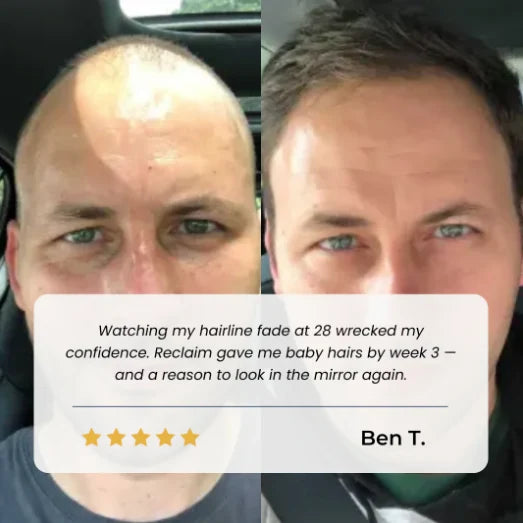 Customer result – hairline regrowth